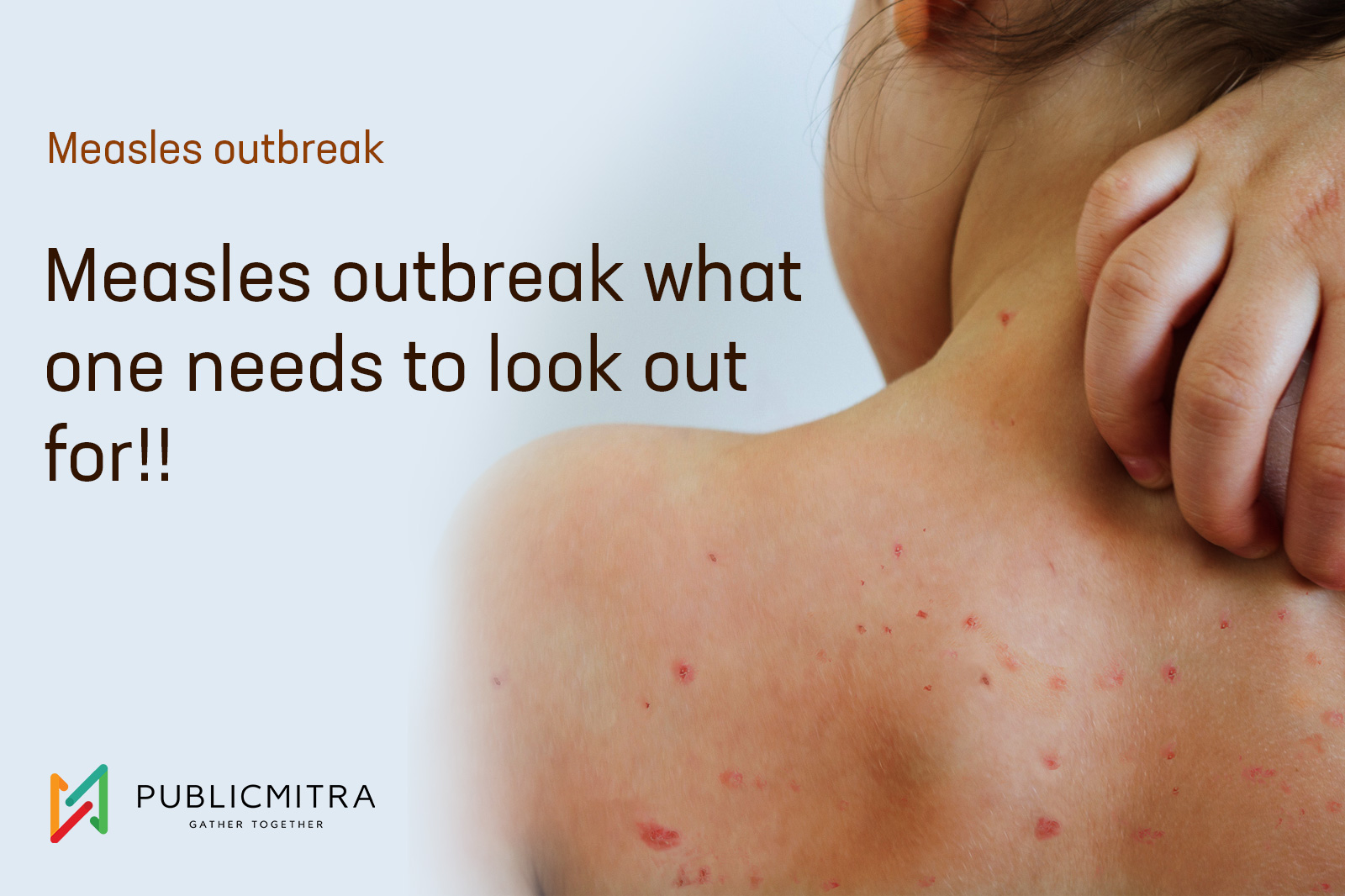 measles-outbreak