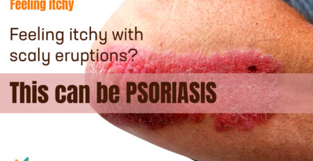 psoriasis