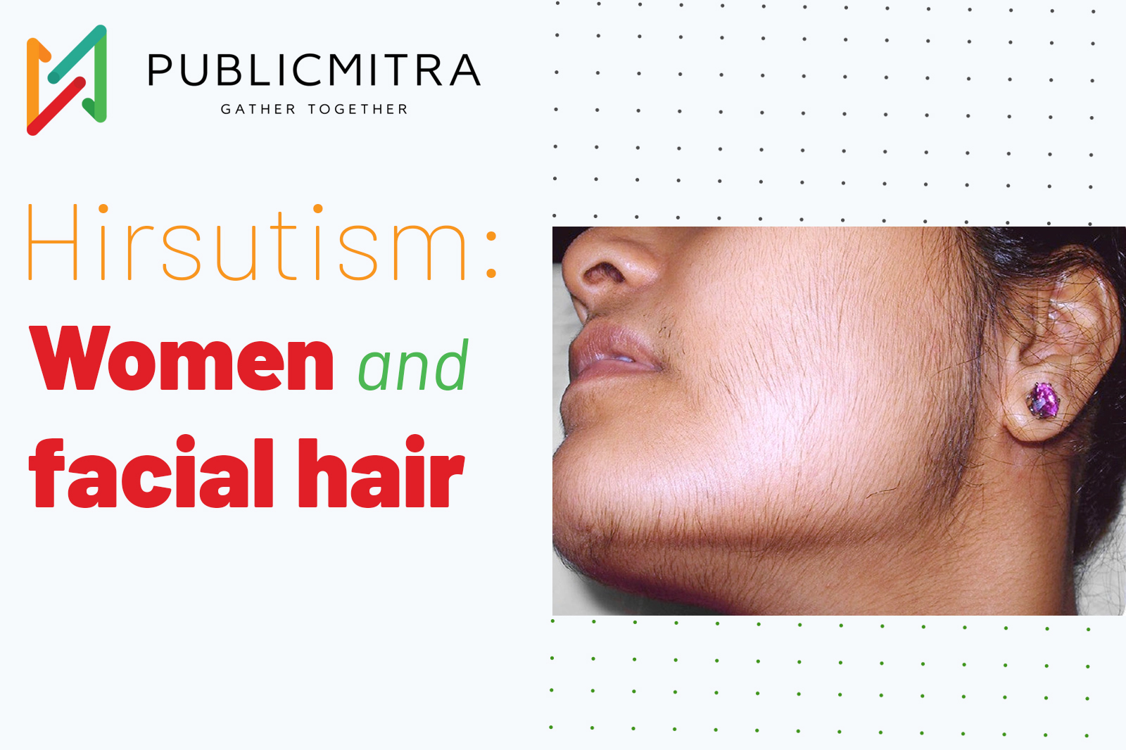 hirsutism-causes